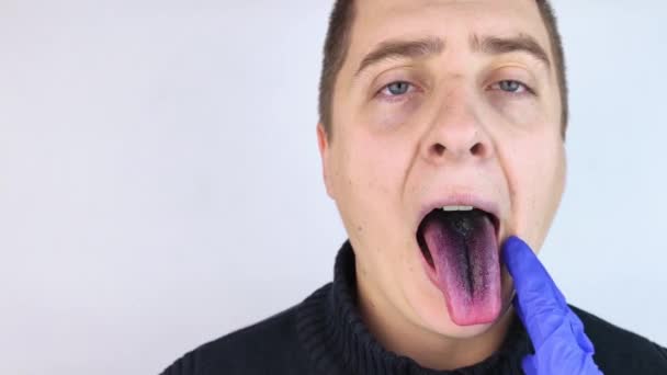 Close-up of a man black tongue. Clinical manifestations of lingua villosa. Bacterial infection of the mouth. The consequences of taking strong antibiotics. Fungal infection - Footage, Video