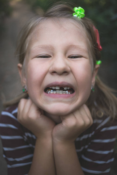 Dítě se zubní ortodontickou pomůckou a bez jednoho zubu. - Fotografie, Obrázek