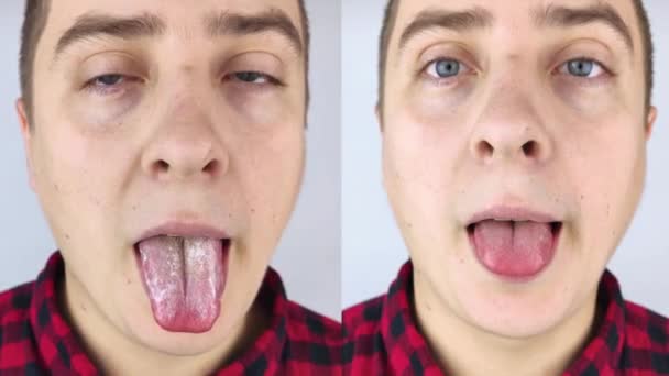Antes y después. Cuajada blanca en la lengua. Un médico o gastroenterólogo examina una lengua masculina. El paciente tiene una higiene bucal deficiente o un síntoma de enfermedad. Síntomas de una enfermedad latente. - Metraje, vídeo