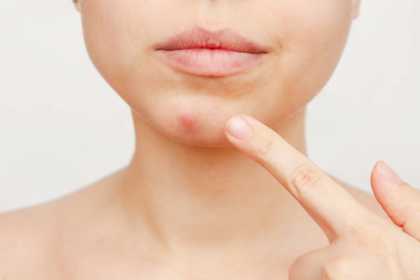 woman with acne pain on face, closeup - Foto, Imagem