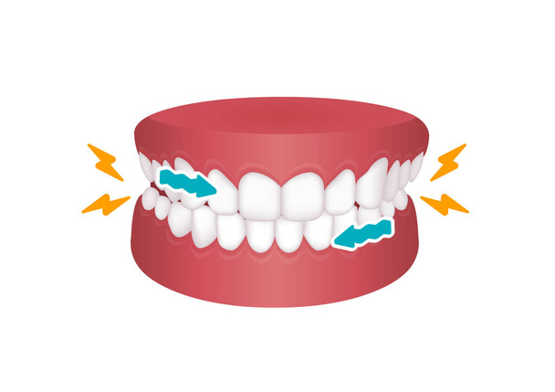 Bruxismo vector ilustración jalá rechinar los dientes - Vector, Imagen
