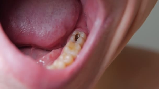 dziura w zębie - Materiał filmowy, wideo