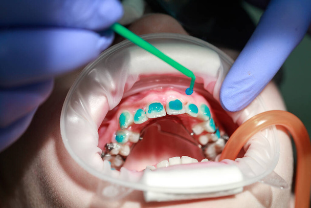 Gravure au Ge sur les dents avant l'installation d'appareils dentaires, dents tordues chez un adolescent, orthodontie, alignement des dents, traitement par un dentiste orthodontiste. - Photo, image