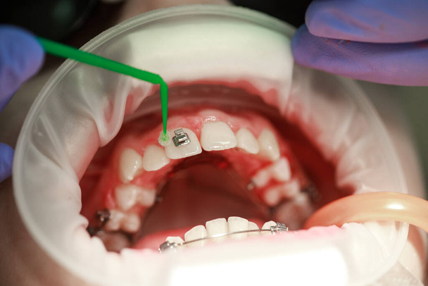 Installation d'accolades sur les dents supérieures. Traitement par un orthodontiste. Concentrez-vous sur les appareils. Netteté sélective. - Photo, image
