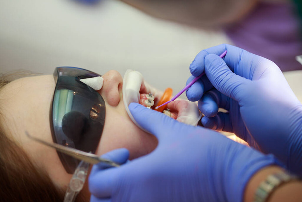 Θεραπεία από έναν οδοντίατρο, ένας ορθοδοντικός βάζει σιδεράκια σε μια έφηβη, εγκαθιστώντας ένα σύστημα σιδεράκια. - Φωτογραφία, εικόνα