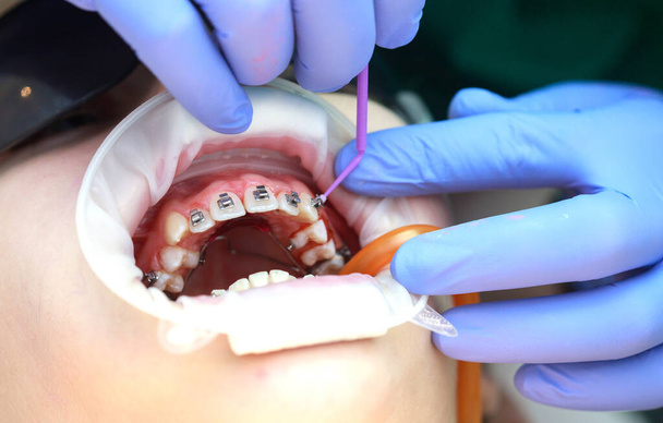 Installation d'accolades sur les dents supérieures. Traitement par un orthodontiste. Concentrez-vous sur les appareils. Netteté sélective. - Photo, image