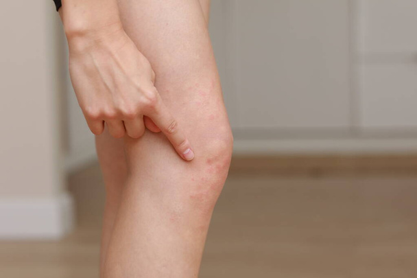 алергія на шкіру, жінок на шкіру ніг. Крупним планом червоні гнійники на коліні, алергічна реакція, викликана атопічним дерматитом. Вибраний фокус
. - Фото, зображення