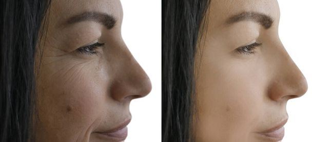 Kadın tedaviden önce ve sonra kırışıklıklarla karşılaşır - Fotoğraf, Görsel