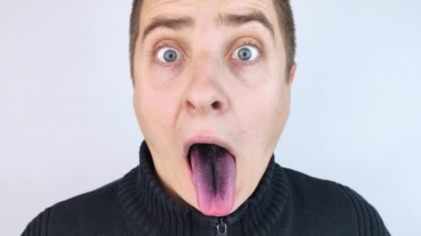 Close-up of a man black tongue. Clinical manifestations of lingua villosa. Bacterial infection of the mouth. The consequences of taking strong antibiotics. Fungal infection - Footage, Video