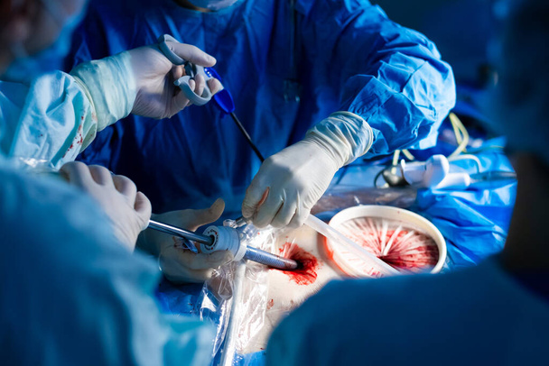 Surgeons operate with laparoscopic manipulators using trocars - Foto, Imagen