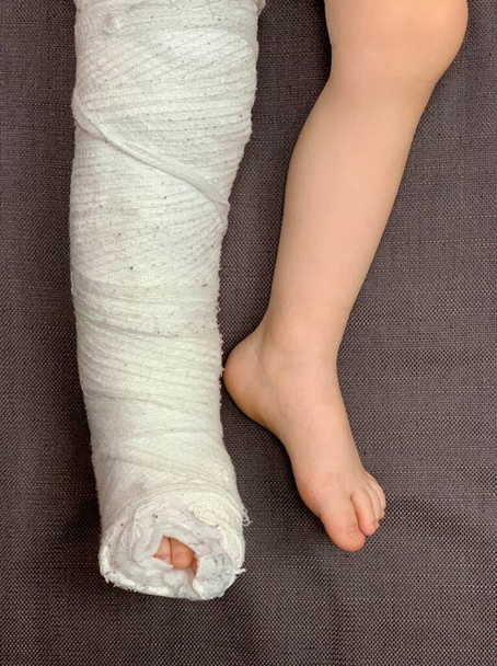 μωρό σπασμένο πόδι σε γύψο, παιδικό τραύμα, κάταγμα οστού, τραυματισμό - Φωτογραφία, εικόνα
