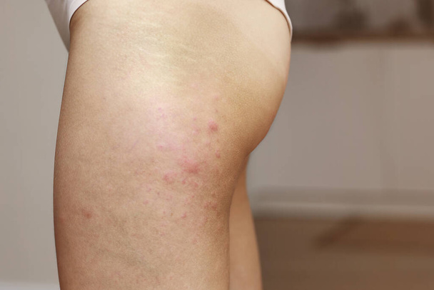 skin allergies, hips skin women. Closeup of red pustules on a hips, an allergic reaction caused by atopic dermatitis. Selected focus. - Photo, Image