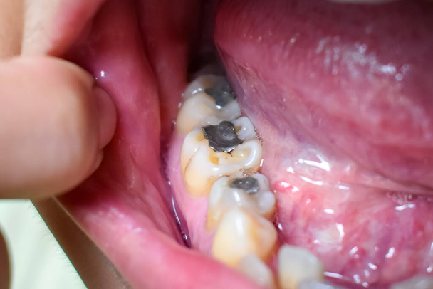 Silber-Amalgamfüllungen am rechten unteren ersten Molaren und linken unteren zweiten Prämolarenzähnen bei einem asiatischen, jungen Mann. Zahnkaries gibt es auch bei schlechter Mundhygiene. - Foto, Bild