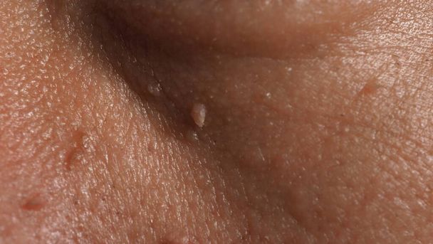 Βράχος στο πρόσωπο. Μακρο βολη κονδυλου κοντα στο ματι. Θηλωμάτων στο δέρμα γύρω από τη μύτη και το λαιμό των ματιών. Κοντινό πλάνο του εκ γενετής σημάδι Παπίλα ή ελιά στο δέρμα. μικρό σκληρό. καλοήθης ανάπτυξη στο δέρμα. προκαλείται από ιό. φροντίδα του δέρματος. - Φωτογραφία, εικόνα