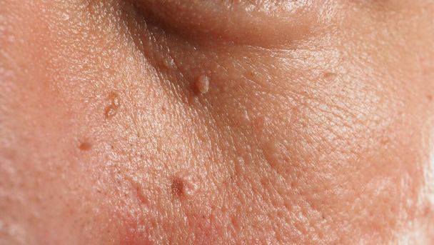 顔を警戒しろ。眼の近くでのウォートのマクロショット。鼻や首の周りの皮膚上の乳頭腫.皮膚の上の母斑パピラまたはモルの閉鎖。小さなハード。肌に優しい成長。ウイルスによるものです。スキンケア. - 写真・画像