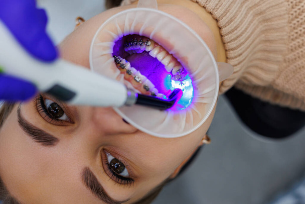 В клинике лечат женские зубы с металлическими брекетами. Ортодонт использует стоматологические инструменты для размещения брекетов на зубах пациентов. Селективный фокус - Фото, изображение
