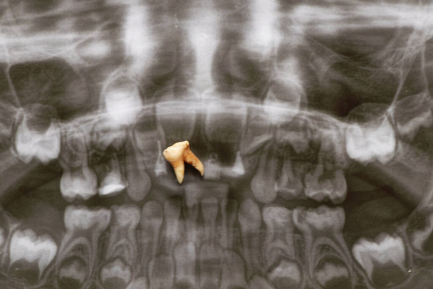 L'immagine panoramica mostra diversi denti incorporati e impattati come su quello superiore, denti per bambini, il dente estratto si trova nelle immagini - Foto, immagini