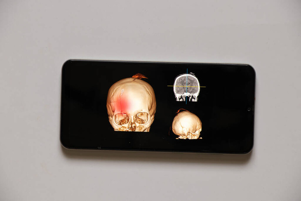 Telefon ekranlarında yaralandıktan sonra kafatasının ön kısmında kırık olan beynin 3 boyutlu tomografisi, mobil uygulama. - Fotoğraf, Görsel