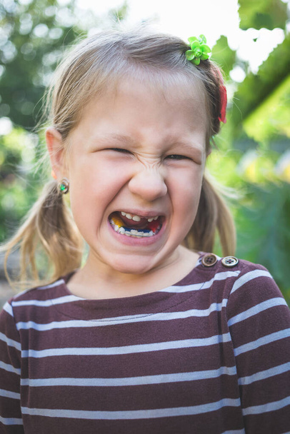 Dziecko z ortodontą dentystyczną i bez jednego zęba. - Zdjęcie, obraz