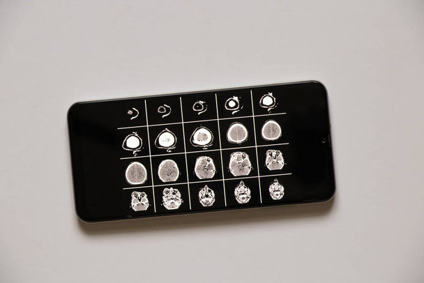 3D počítačová tomografie mozku se zlomeninou čelní části lebky po poranění na obrazovkách telefonu, mobilní aplikace - Fotografie, Obrázek