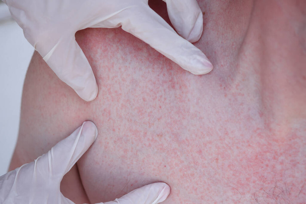 Doctor hands in gloves examining red rash on patient skin closeup - Fotografie, Obrázek
