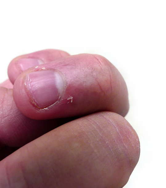 descamación de la piel en las uñas, deficiencia de vitamina C y enfermedades de la piel de las uñas, - Foto, imagen