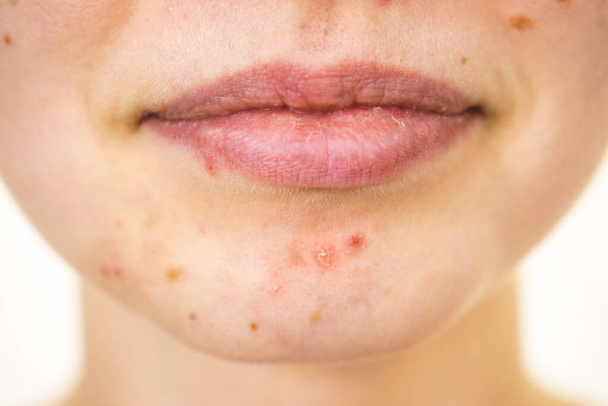 Young woman showing her face with acne and moles, dry lips. Teen girl no make up with red spots on her chin. Health problem, skin diseases. - Фото, изображение