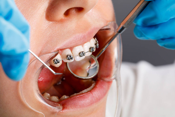 A young woman with metal braces is being examined by an orthodontist. Correction of the bite of teeth in the dental clinic. Concept of healthy teeth. - Photo, image