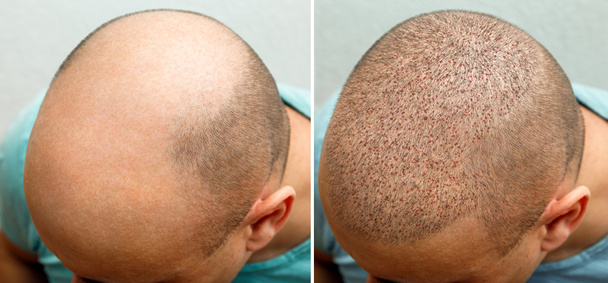 Το κεφάλι ενός φαλακρού άντρα πριν και μετά την εγχείρηση μεταμόσχευσης μαλλιών. Ένας άντρας που χάνει τα μαλλιά του έχει γίνει μαλλιαρός. Διαφημιστική αφίσα για κλινική μεταμόσχευσης μαλλιών. Θεραπεία της φαλάκρας. - Φωτογραφία, εικόνα