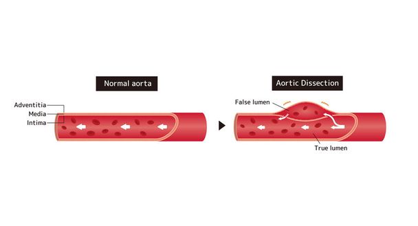 Confronto illustrazione della normale aorta e dissezione aortica  - Vettoriali, immagini