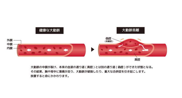 Ilustración comparativa de aorta normal y disección aórtica (japonés) - Vector, imagen