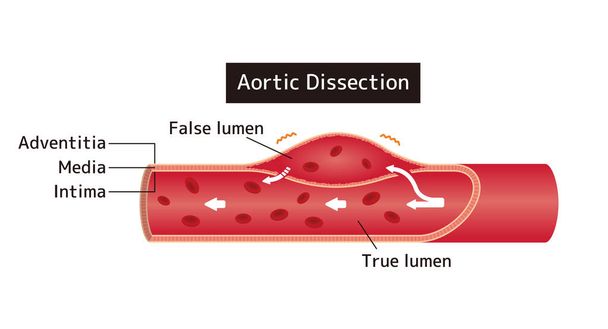 Vektorová ilustrace disekce aorty  - Vektor, obrázek
