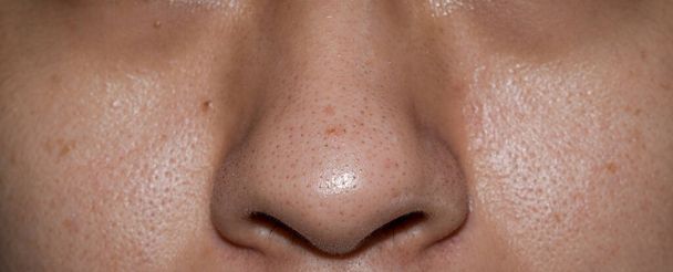 Punti neri o teste nere su naso di uomo asiatico. Sono piccoli urti che compaiono sulla pelle a causa di follicoli piliferi ostruiti. - Foto, immagini