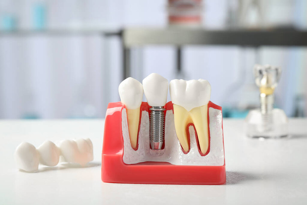 Educational model of gum with dental implant between teeth on white table indoors - Foto, Imagen