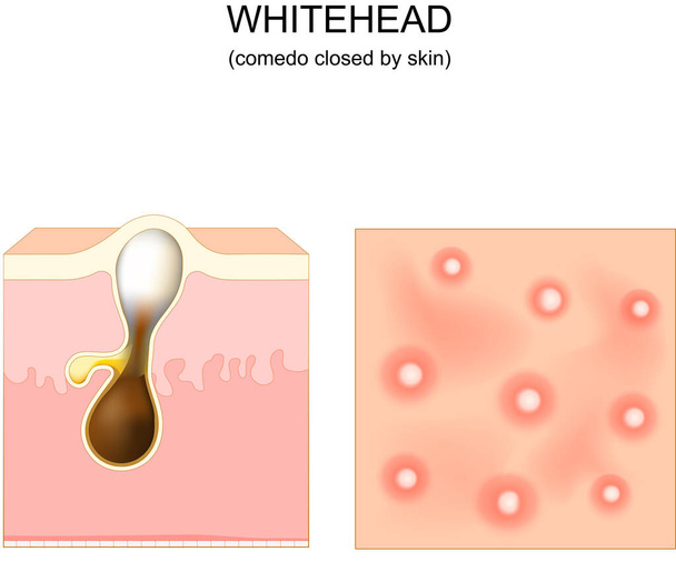 Acne. whitehead. clogged pore and comedo. Cross-section of a human skin with Hair follicle. Top view of the skin with pimples. Vector illustration. poster - Vettoriali, immagini