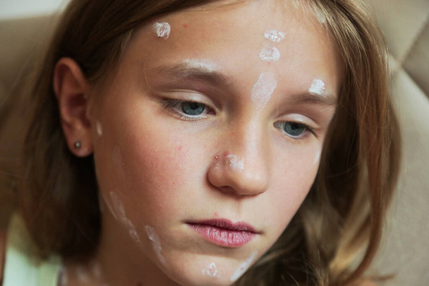 Cute little girl with chickenpox at home. Varicella zoster virus. - Foto, Bild