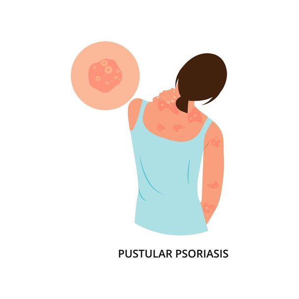 The woman is scratching her back.  Pustular psoriasis.Allergic itching, skin inflammation, redness and irritation. Atopic dermatitis, eczema, psoriasis, dry skin. Skin problems Concept, isolated, vector. - Vector, Image