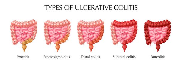 Colitis ulcerosa Tipos Infografías - Vector, imagen