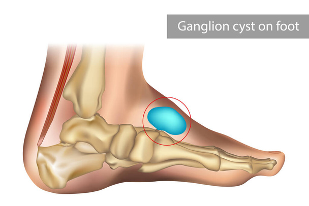 Medical vector illustration of ganglion foot cyst with bones. Big ganglion cysts,a sac of jelly like fluid,is on the foot of man put - Вектор,изображение
