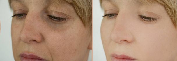 nainen kasvot ryppyjä ennen hoitoa ja sen jälkeen - Valokuva, kuva