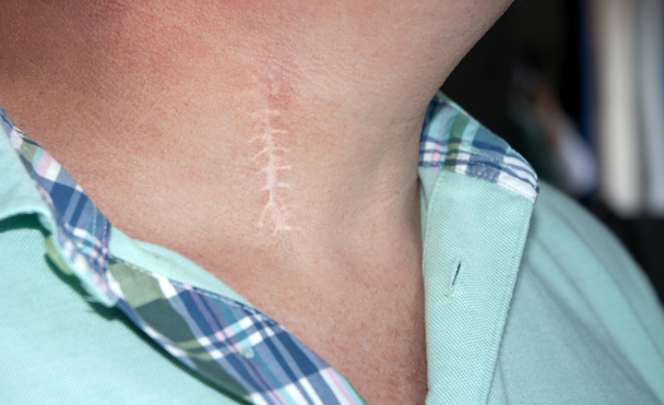 Litteken links in de nek na een chirurgische ingreep van een cervicale hernia - Foto, afbeelding