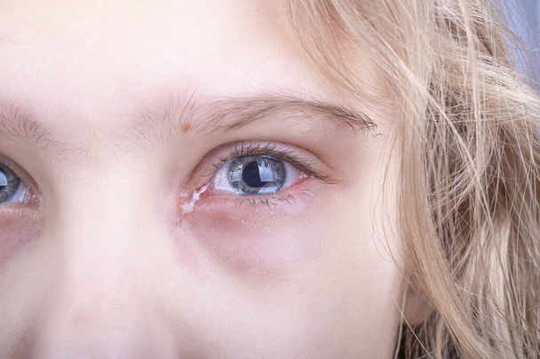close-up. a girl with white hair. a tear flows from the eye, it is red, there is a discharge of pus. skin rash. very strong fragmentation. doctor's examination - Photo, Image