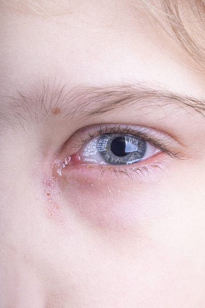 close-up. a girl with white hair. a tear flows from the eye, it is red, there is a discharge of pus. skin rash. very strong fragmentation. doctor's examination - Photo, Image
