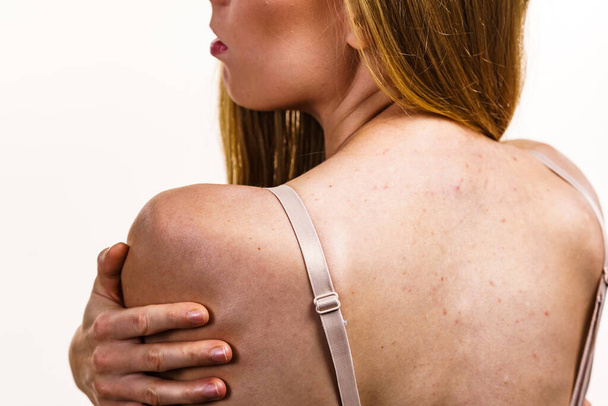 Health problem, skin diseases. Young woman showing her back with acne, red spots. Teen girl with many pimples. - 写真・画像