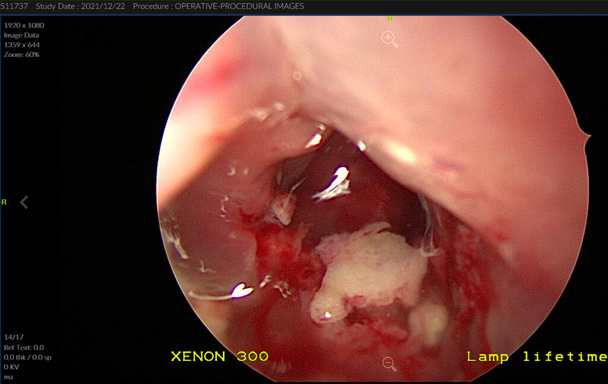 Cirugía endoscópica de drenaje sinusal y desbridamiento - pus amarillo-verde - Foto, imagen