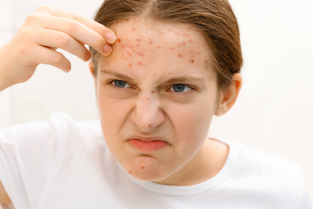 face of a teenage girl with pimples, she looks at herself in the mirror and touches face with her hand, acne on the skin, concept of beauty and health - Photo, Image
