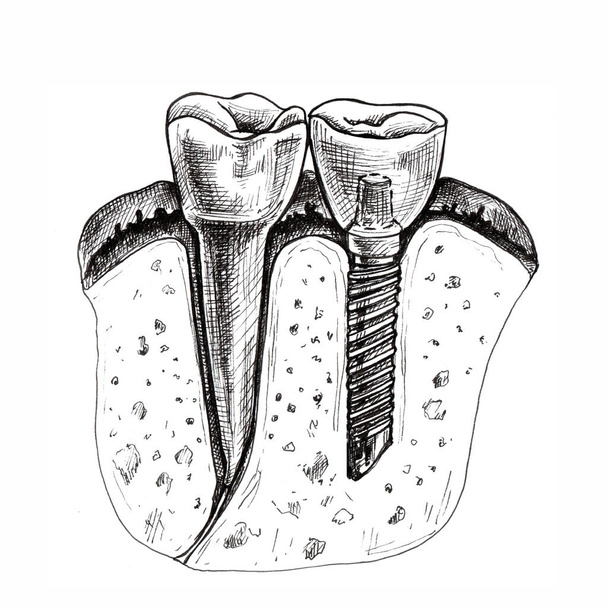 dent saine, implanté, dessin à la main, graphiques, restauration dentaire - Photo, image