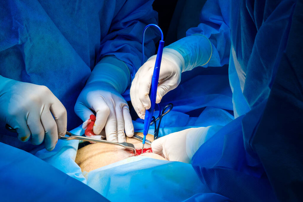The surgeon holds the electrical coagulator during the operation. - Foto, afbeelding