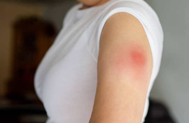 Vaccination reaction on arm of woman after injection of covid corona virus vaccine. Partie gonflée, site de ponction rouge. Personne méconnaissable. - Photo, image
