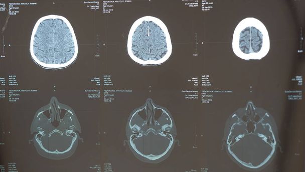 Resonancia magnética del cerebro
 - Foto, imagen
